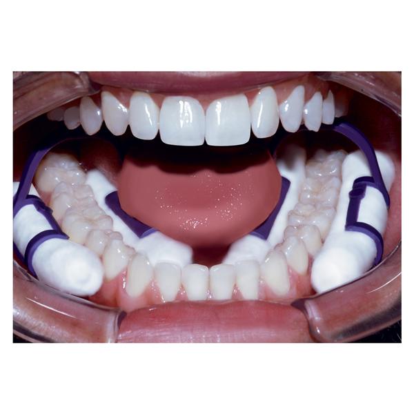 Pascal 28-100 Isolator Cotton Roll Dental Holder Purple Disposable 50/Bx Pascal 28-100 Isolator Cotton Roll Dental Holder Purple Disposable 50/Bx